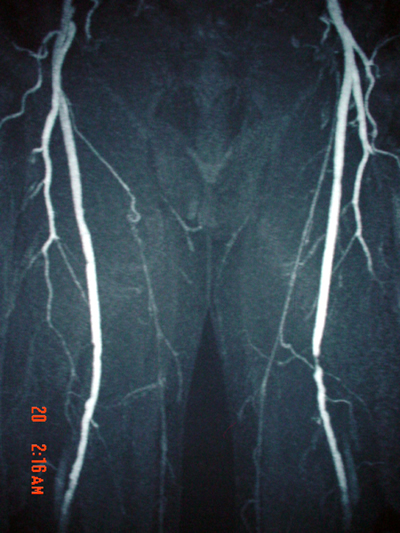 posterior tibial artery. posterior tibial artery